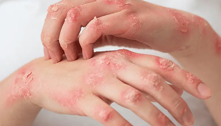 Understanding Modern Approaches to Managing Chronic Skin Conditions